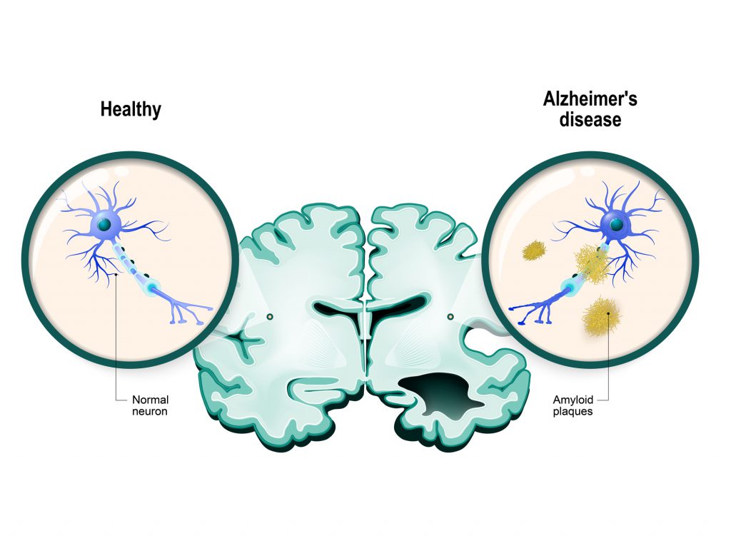 Do I Have Dementia? The Ultimate List Of Dementia Tests